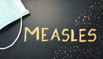 חצבת - תמונת המחשה